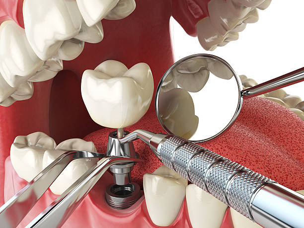 Best Emergency Dental Care for Broken or Chipped Teeth in University, MS
